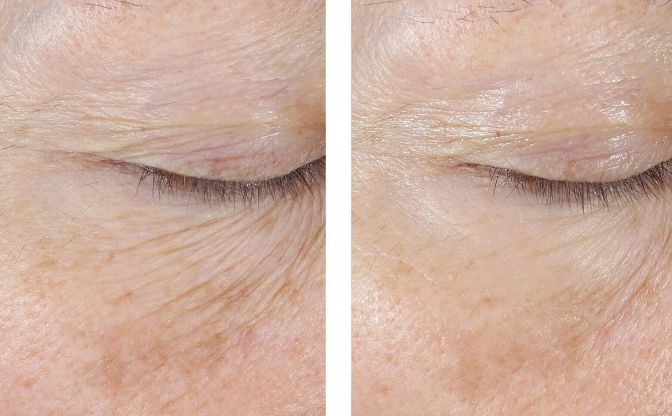 InterFuse Treatment Cream EYE